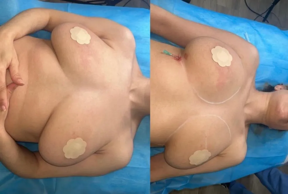 Empire Medical Clinic Botox 2